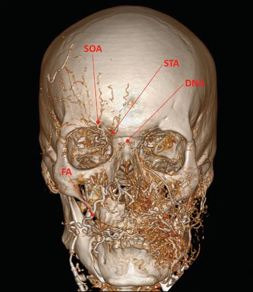 Fig 7. Internal and external carotid territories on contrast CT